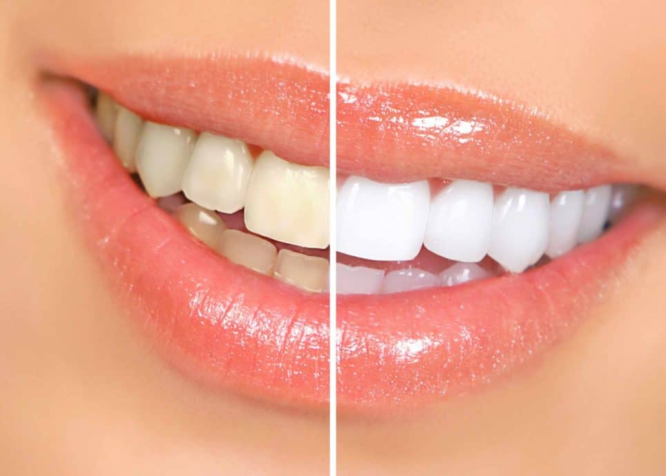 Naturally Whiten Your Teeth at Home Hindi
